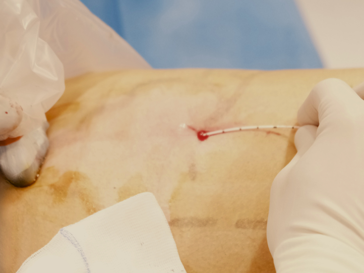 Laser dans la varice sous contrôle échographique