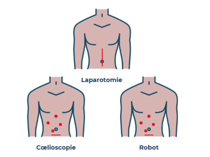 Schema_intervention2