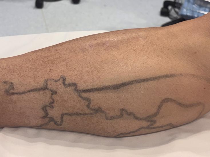 Marquage des varices réalisé par l'Angiologue avant l'intervention 