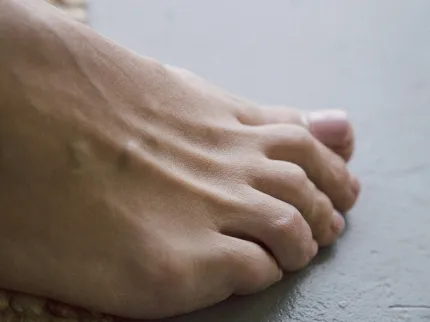 Zoom sur un pied après l'opération chirurgicale de l'Hallux Valgus, groupe Vivalto Santé