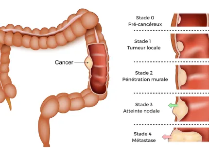 Types et stades du cancer colorectal