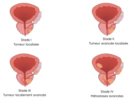 Différents stades du cancer de la prostate