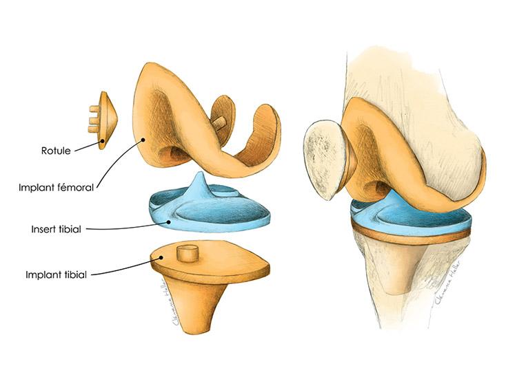 Illustration traitement prothèse de genou vue éclatée