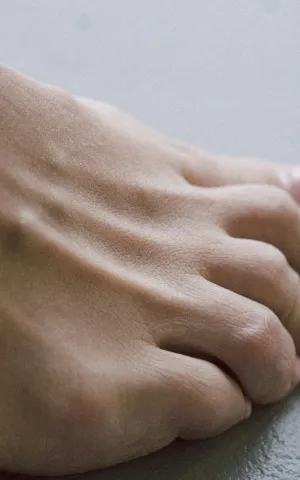 Zoom sur un pied après l'opération chirurgicale de l'Hallux Valgus, groupe Vivalto Santé