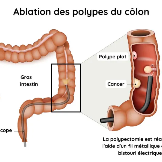 Ablation des polypes du côlon