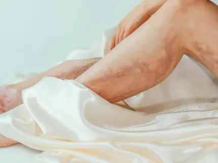 varices