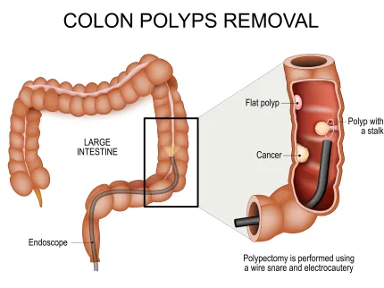 Cancer colorectal - Retrait des polypes
