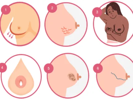 Signes du cancer du sein