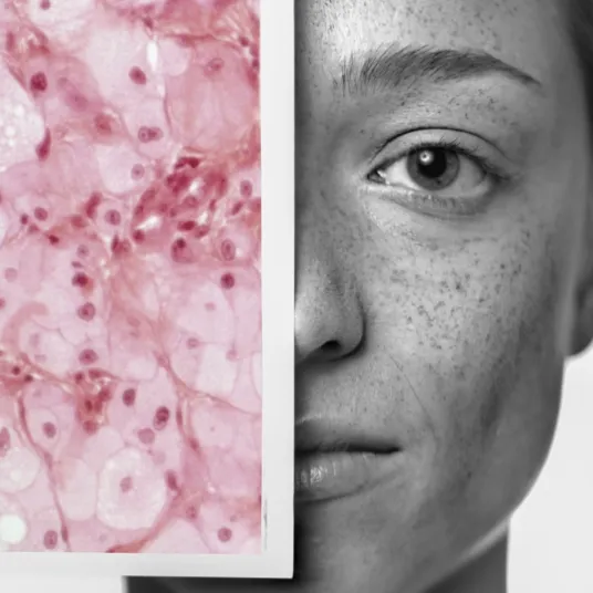 Dermatologie laser - Illustration