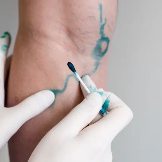 Chirurgie Vasculaire et Thoracique - ILLUSTRATION