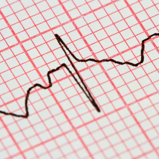 Électrocardiogramme (ECG)