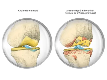Illustration traitement prothèse de genou anatomie normale et anatomie pré-intervention