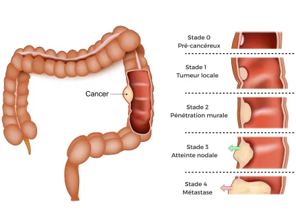 Stades du cancer colorectal