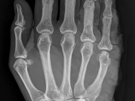 Photo d'une radio de la main