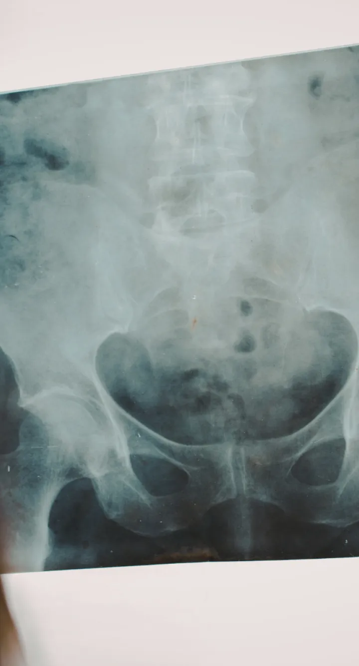 SOS Tumeurs Pelviennes