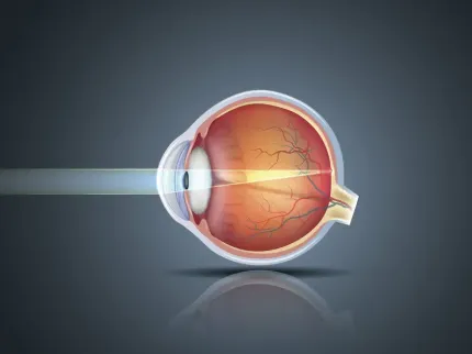 Image représentant l'injection Intra-Vitréenne (IVT) pour le Groupe Vivalto Santé