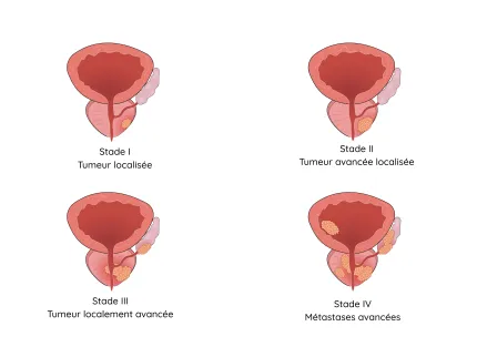 Cancer de la prostate - Stades