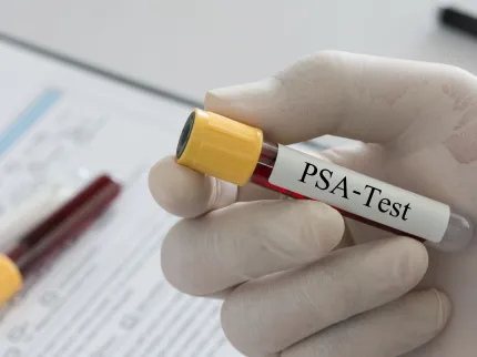 Cancer de la prostate - Test PSA