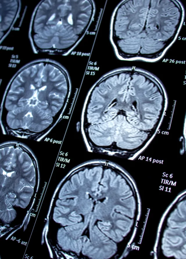 Imagerie du cerveau