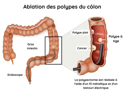 Ablation des polypes du côlon
