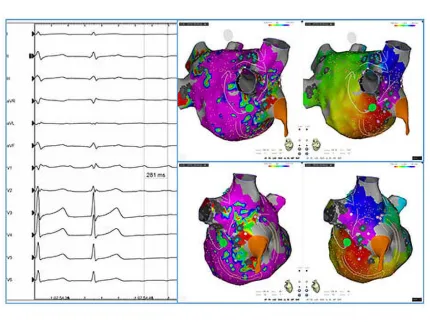Rythmologie interventionnelle - Polyclinique Lyon-Nord