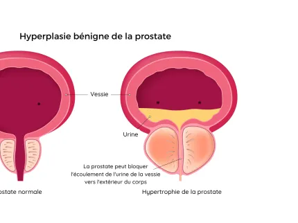 Hyperplasie bénigne de la prostate 