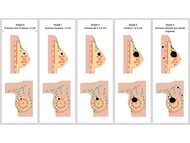 Stades du cancer du sein