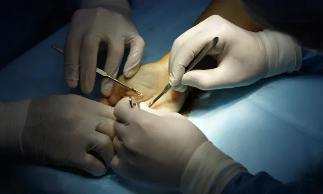 Chirurgie de la main